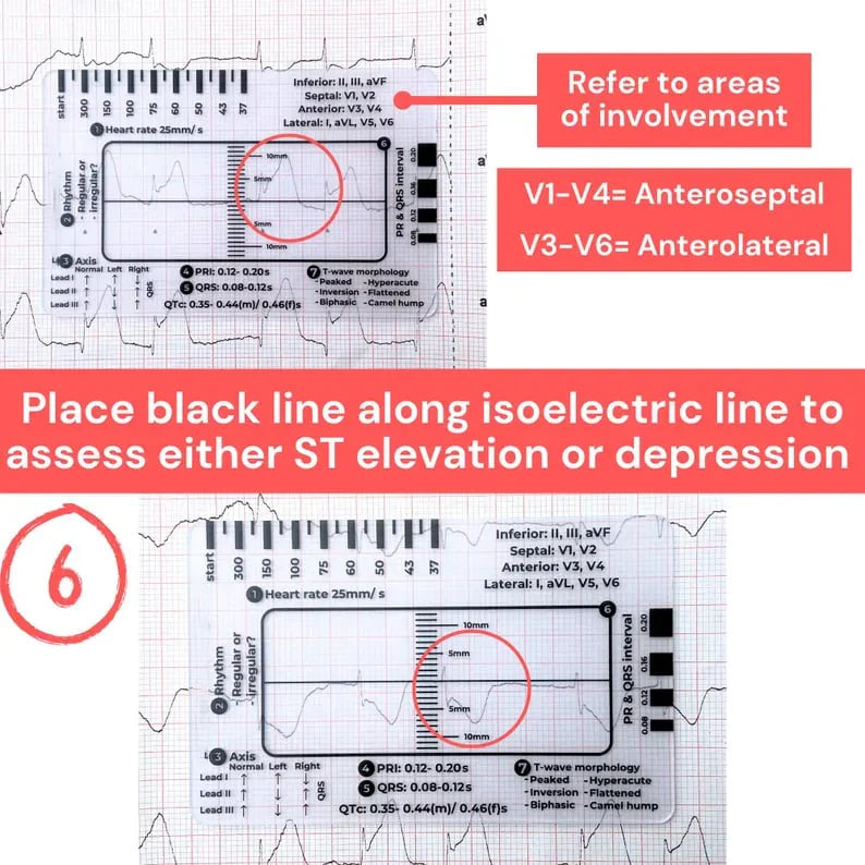 CardioScale™ - ECG 7 Step Ruler